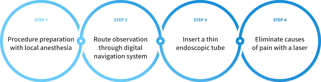 STEP1 - Procedure preparation with local anesthesia, STEP2 - Route observation through digital navigation system, STEP3 - Insert a thin endoscopic tube, STEP4 - Eliminate causes of pain with a laser