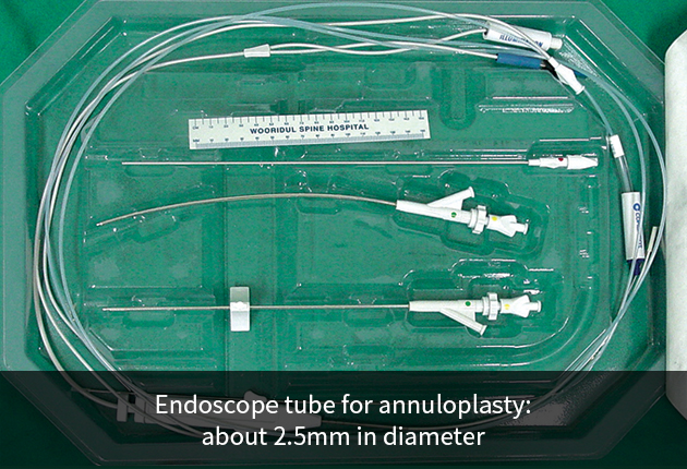 Endoscopic Annuloplasty (Cervical)