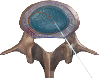 Principles of Nucleoplasty