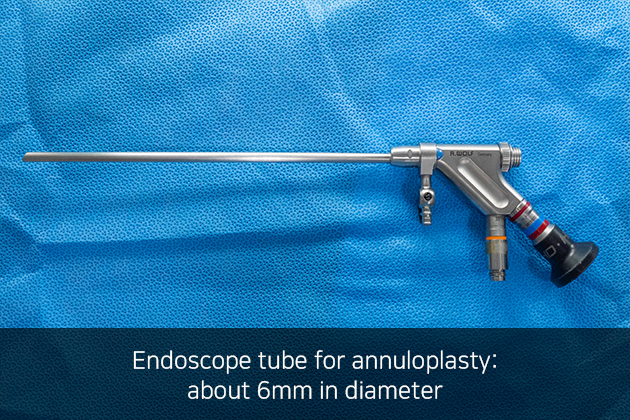 Endoscopic Annuloplasty