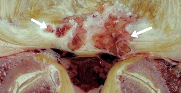 Ingrowth of vascularized granulation tissue along with chronic inflammation