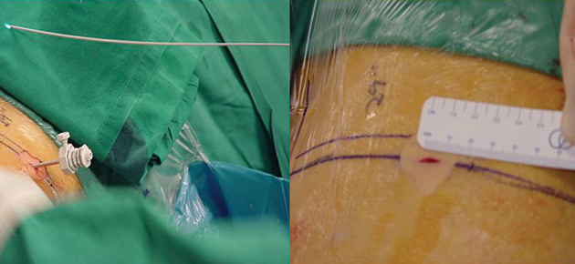 The endoscope tube is only 2.5mm in diameter, there is no scars after the procedure.