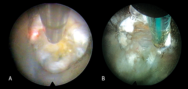 A. Only the lesional disc is contracted with a laser through the endoscope, B. Only the lesional annulus fibrosus is selectively treated with high-frequency heat through the endoscope