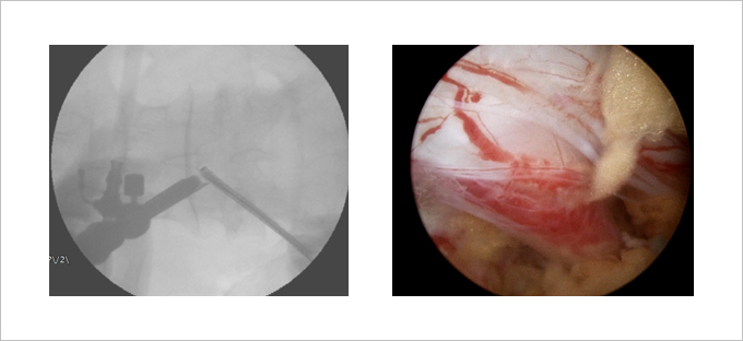 Unilateral Biportal Endoscopic Spine Surgery