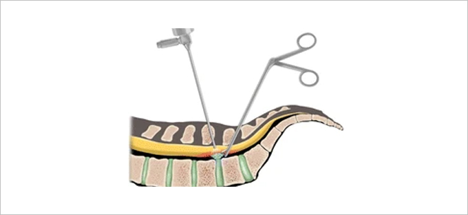 Unilateral Biportal Endoscopic Spine Surgery