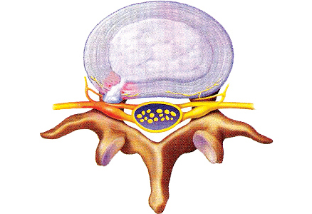 When a herniated disc compresses a nerve root, it can cause back or leg pain.