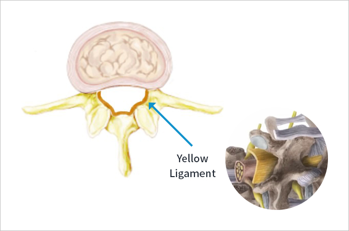 Yellow Ligament
