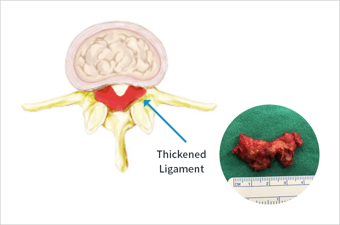 Thickened Ligament