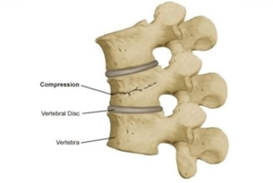 Treatment for Spine Compression Fracture