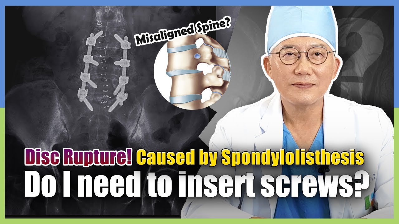 Do I Really Have to Insert Screws for Disc Rupture Caused by Spondylolisthesis?