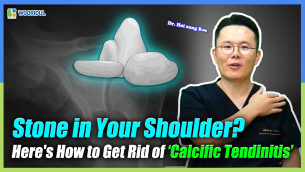 Calcific Tendinitis: The Stone in Your Shoulder