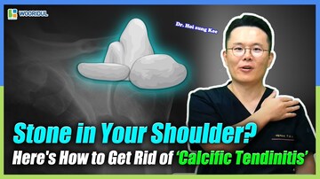 Calcific Tendinitis: The Stone in Your Shoulder